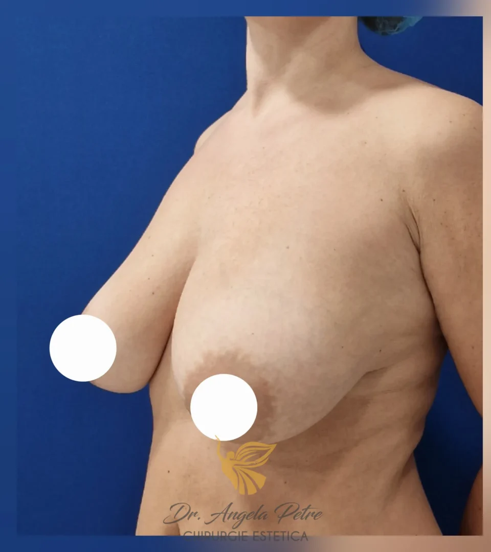 Caz 01 Mastopexie (ridicare sâni lăsați), semiprofil, before, Dr. Angela Petre - București