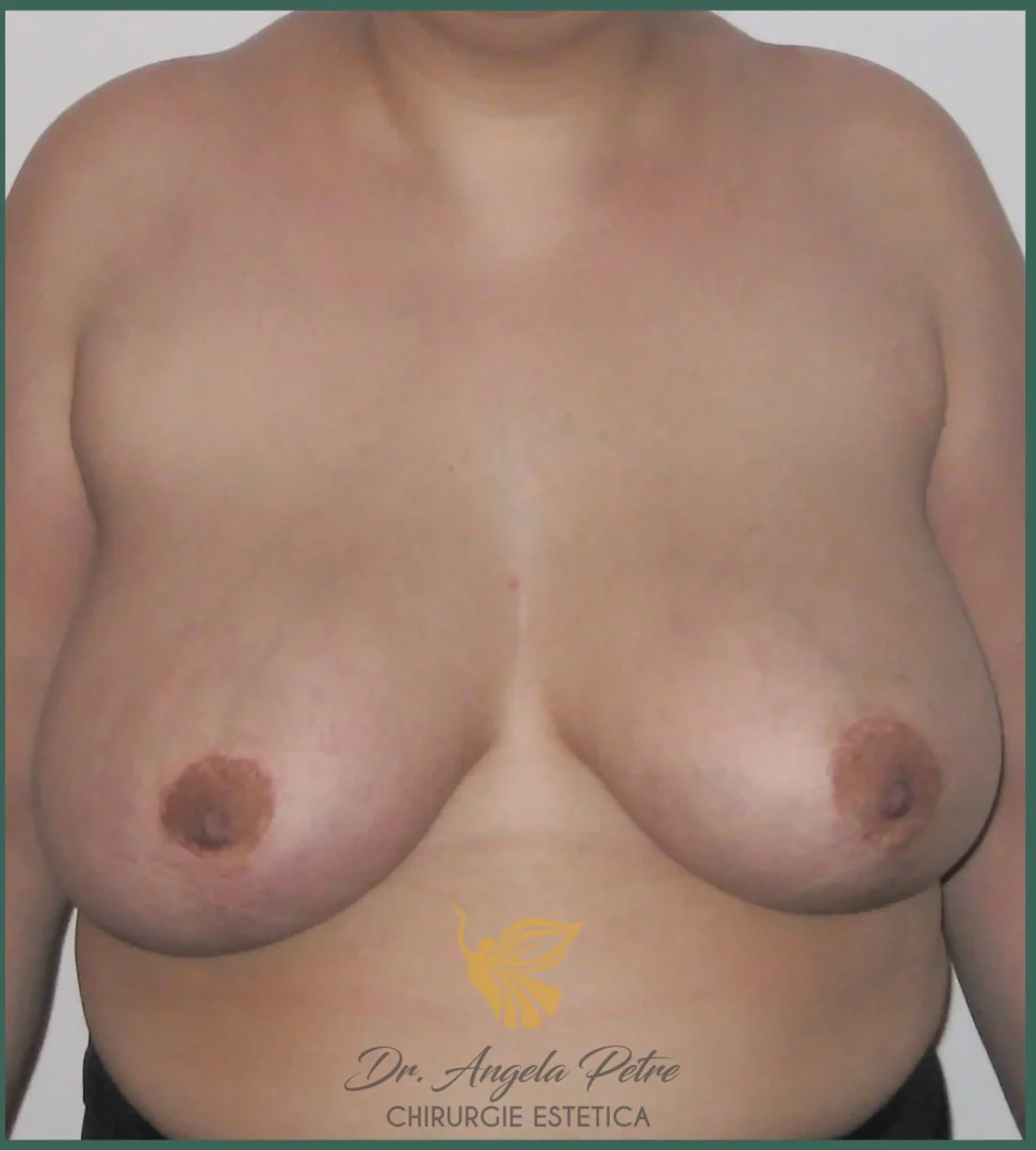 Caz 24 Mastopexie (ridicare sâni lăsați), frontal, after, Dr. Angela Petre - București