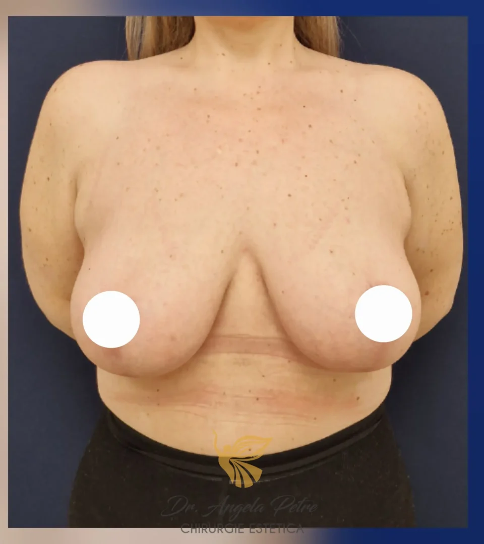 Caz 02 Mastopexie (ridicare sâni lăsați), frontal, after, Dr. Angela Petre - București