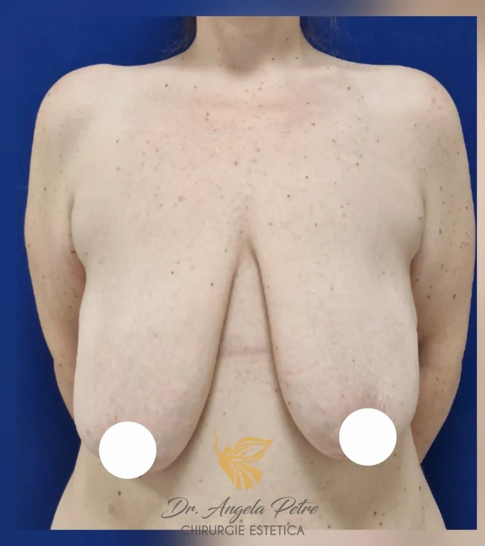 Caz 02 Mastopexie (ridicare sâni lăsați), frontal, before, Dr. Angela Petre - București