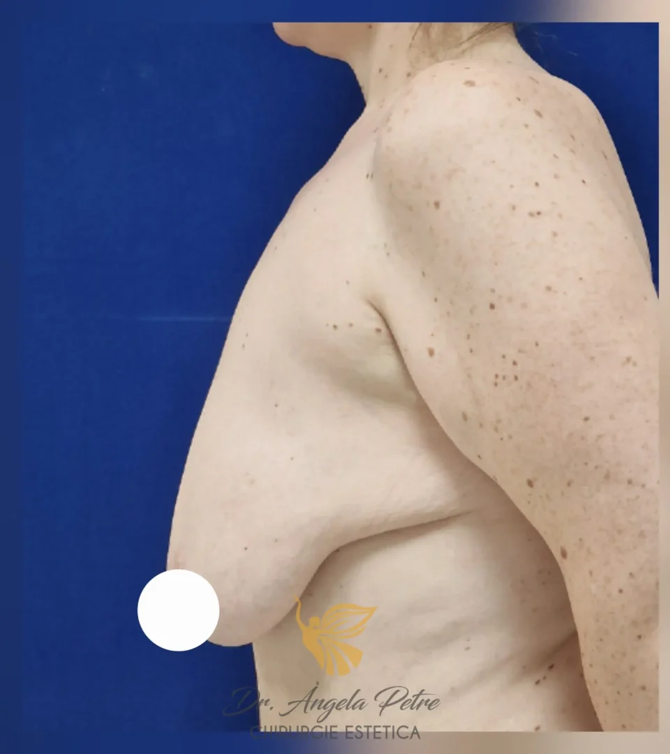 Caz 02 Mastopexie (ridicare sâni lăsați), profil, before, Dr. Angela Petre - București