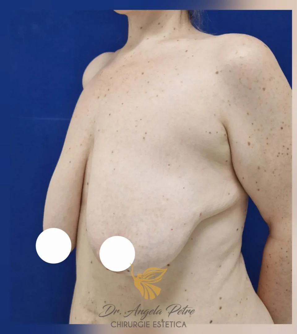 Caz 02 Mastopexie (ridicare sâni lăsați), semiprofil, before, Dr. Angela Petre - București