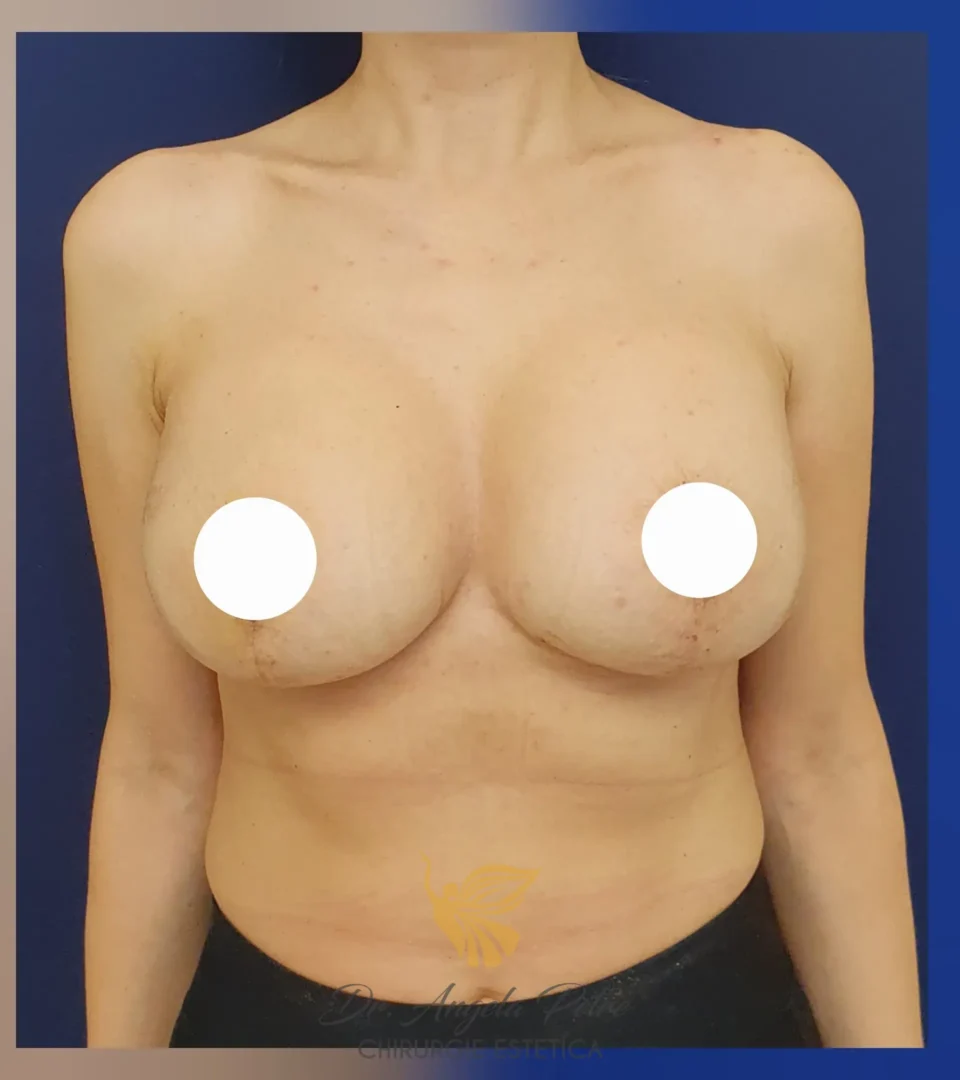 Caz 03 Mastopexie (ridicare sâni lăsați), frontal, after, Dr. Angela Petre - București