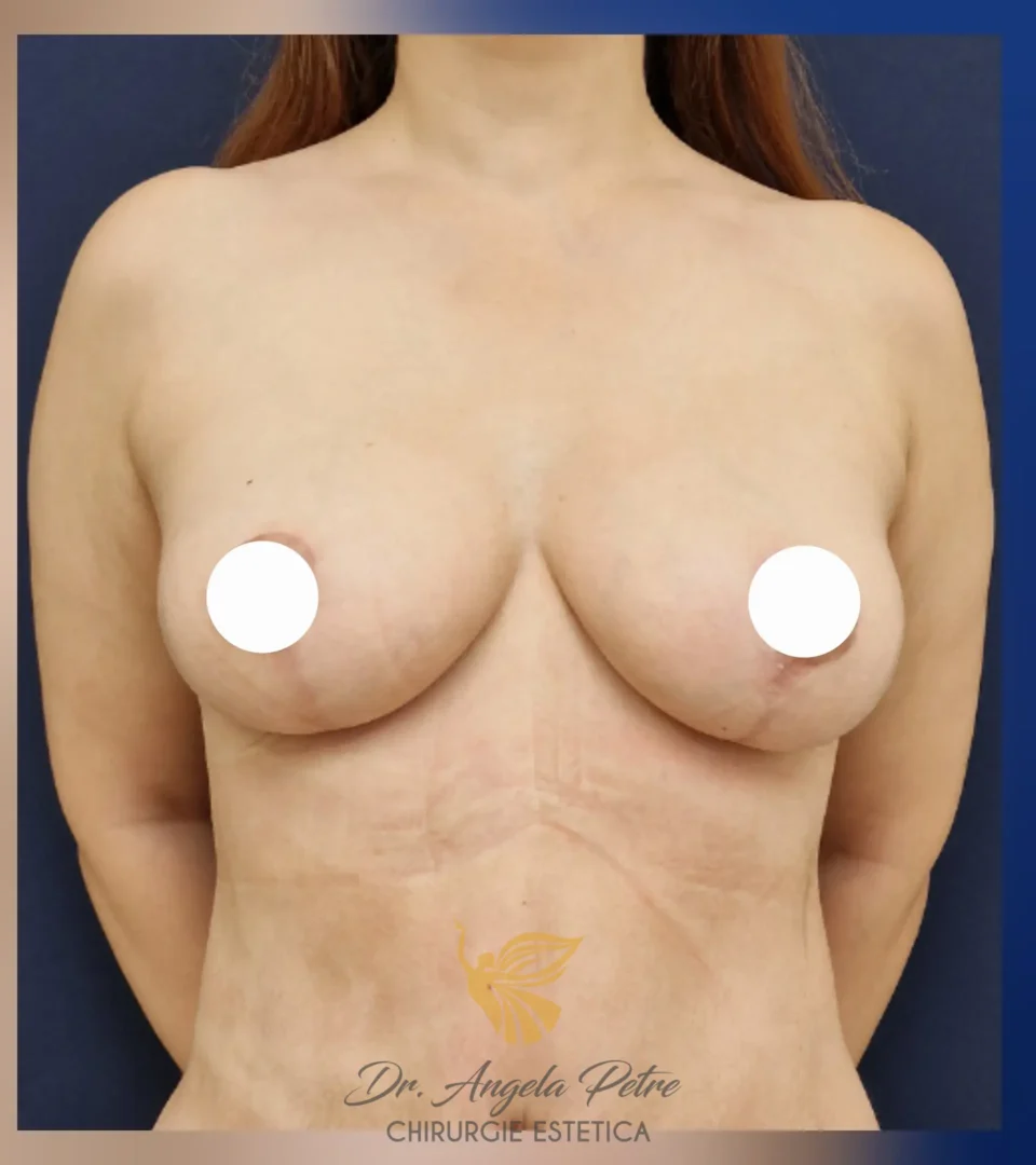 Caz 04 Mastopexie (ridicare sâni lăsați), frontal, after, Dr. Angela Petre - București