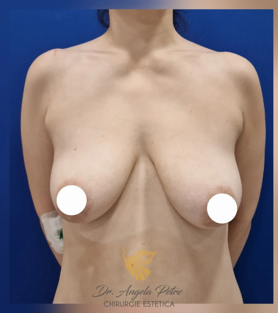 Caz 04 Mastopexie (ridicare sâni lăsați), frontal, before, Dr. Angela Petre - București