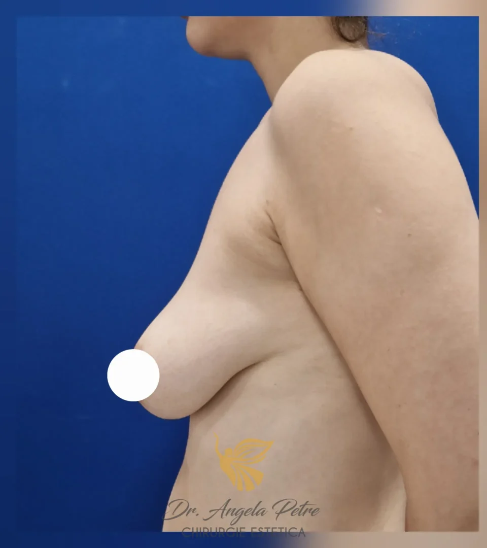 Caz 04 Mastopexie (ridicare sâni lăsați), profil, before, Dr. Angela Petre - București