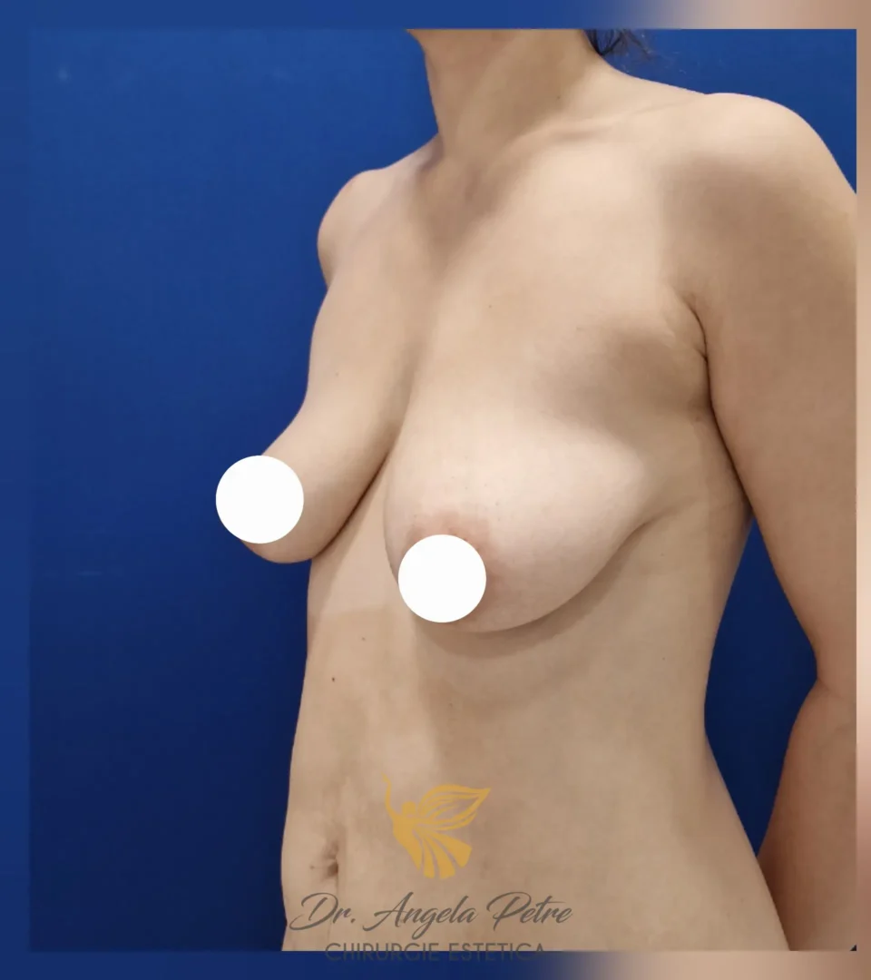 Caz 04 Mastopexie (ridicare sâni lăsați), semiprofil, before, Dr. Angela Petre - București