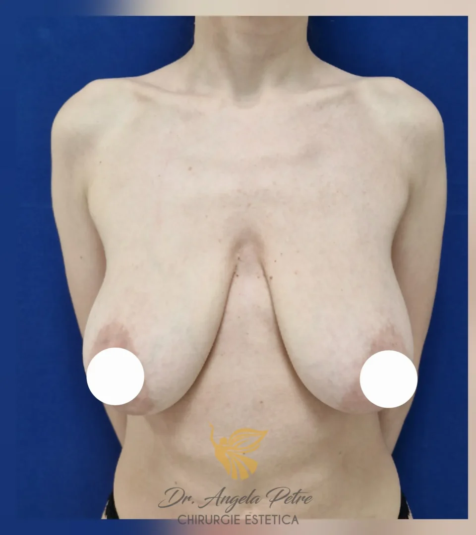 Caz 05 Mastopexie (ridicare sâni lăsați), frontal, before, Dr. Angela Petre - București