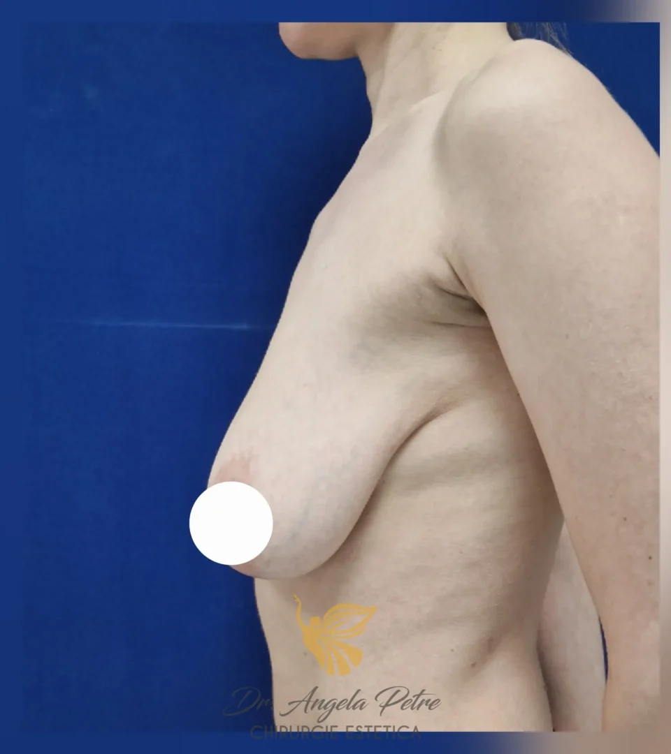 Caz 05 Mastopexie (ridicare sâni lăsați), profil, before, Dr. Angela Petre - București