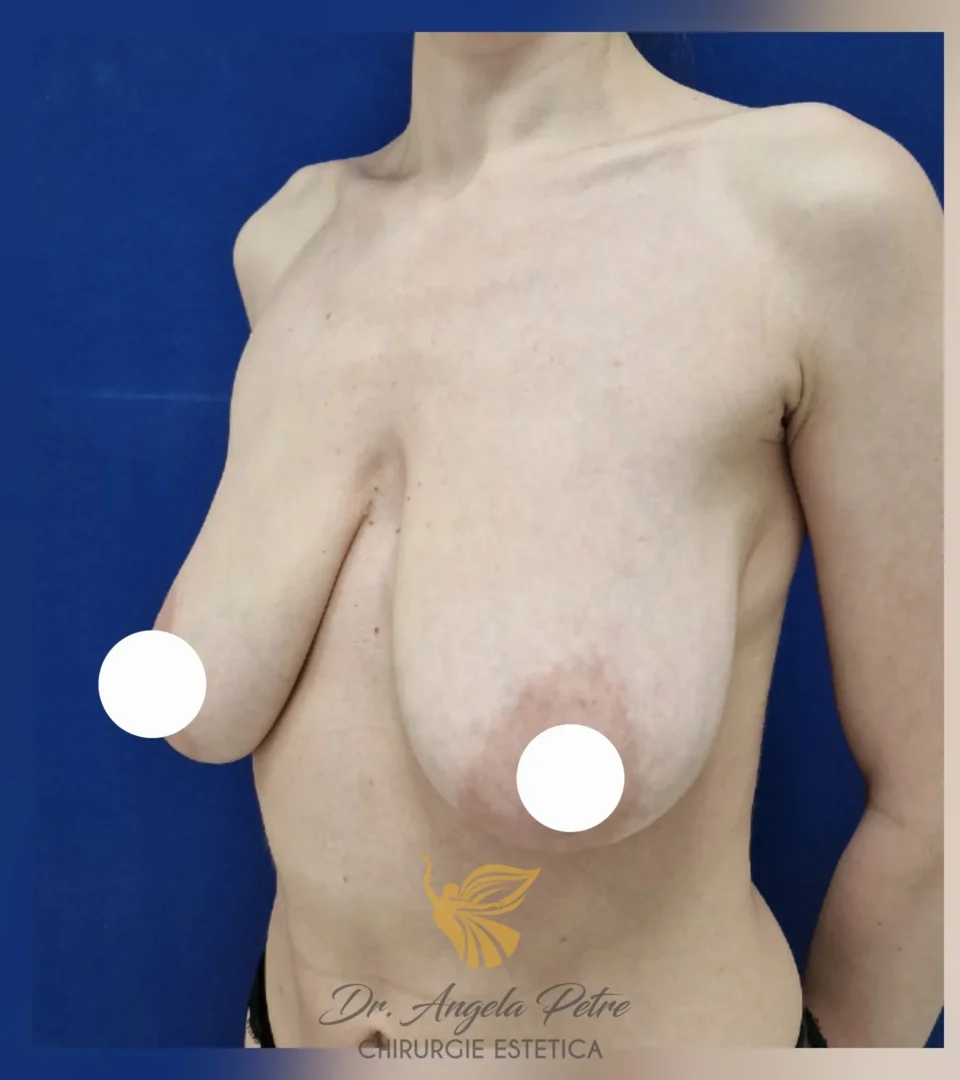 Caz 05 Mastopexie (ridicare sâni lăsați), semiprofil, before, Dr. Angela Petre - București