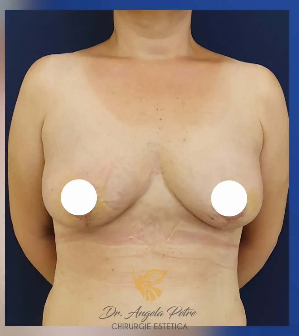 Caz 06 Mastopexie (ridicare sâni lăsați), frontal, after, Dr. Angela Petre - București
