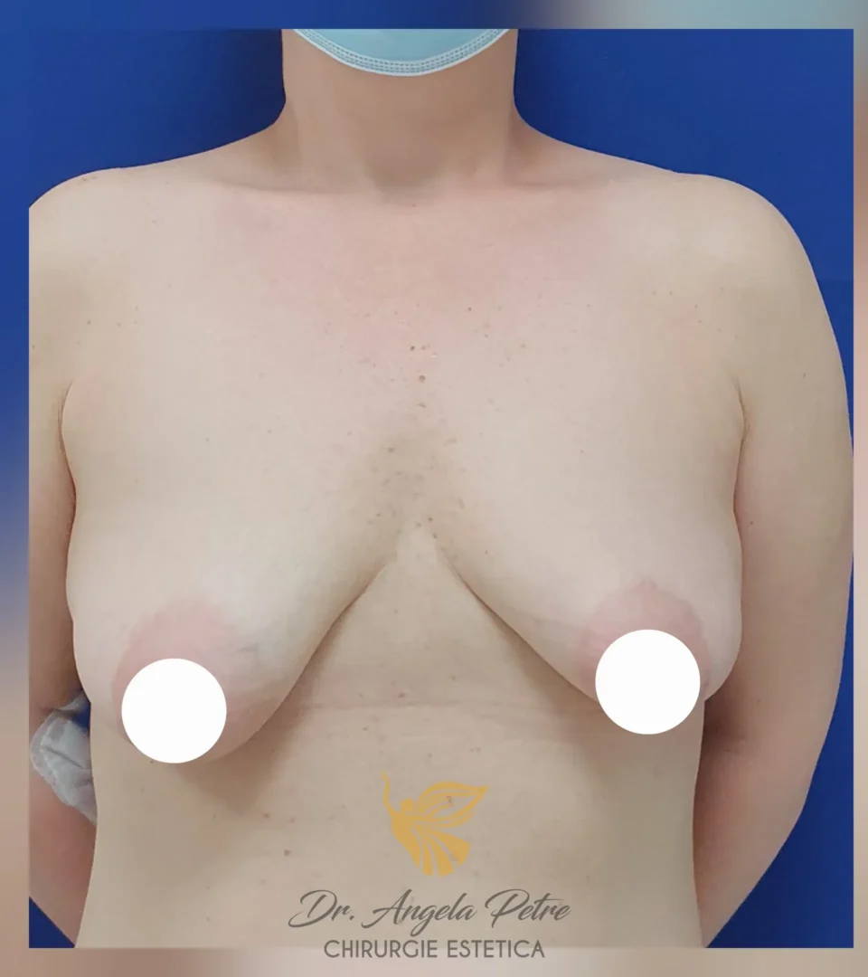 Caz 06 Mastopexie (ridicare sâni lăsați), frontal, before, Dr. Angela Petre - București