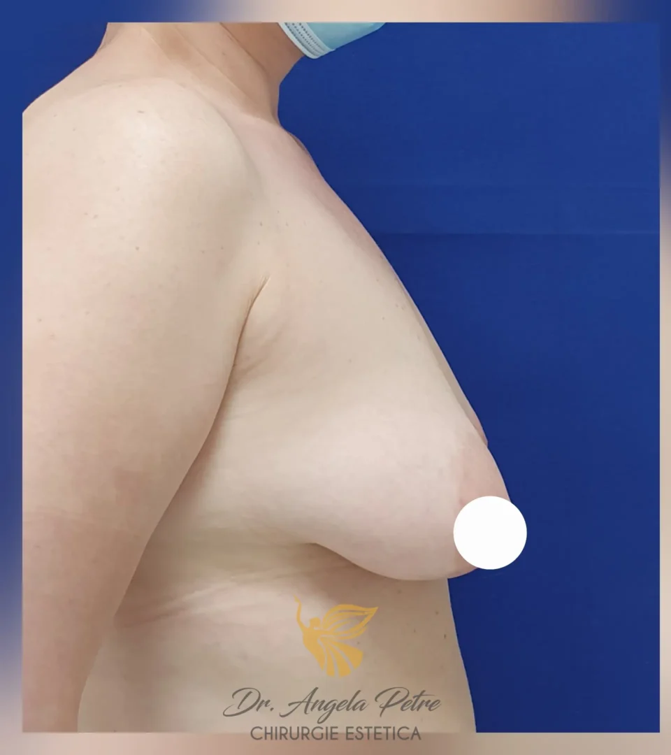 Caz 06 Mastopexie (ridicare sâni lăsați), profil, before, Dr. Angela Petre - București