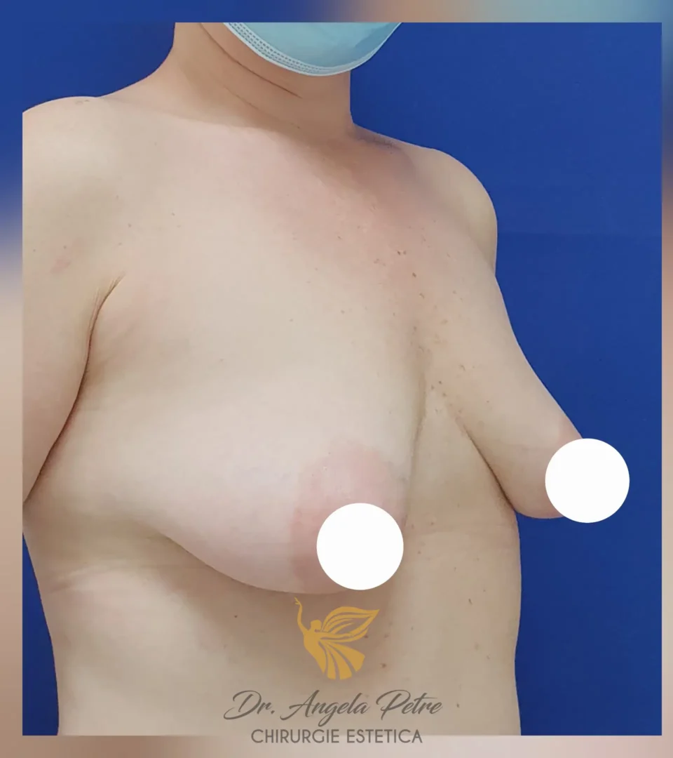 Caz 06 Mastopexie (ridicare sâni lăsați), semiprofil, before, Dr. Angela Petre - București