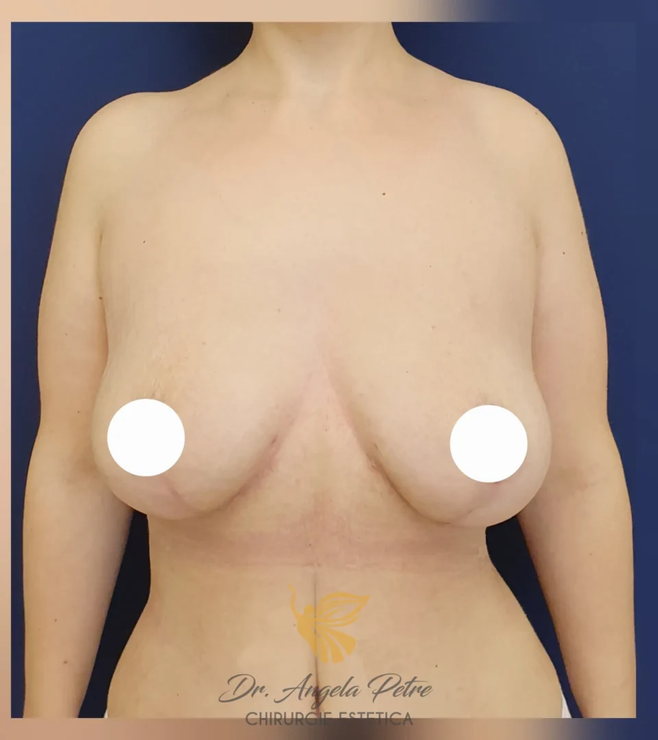 Caz 07 Mastopexie (ridicare sâni lăsați), frontal, after, Dr. Angela Petre - București
