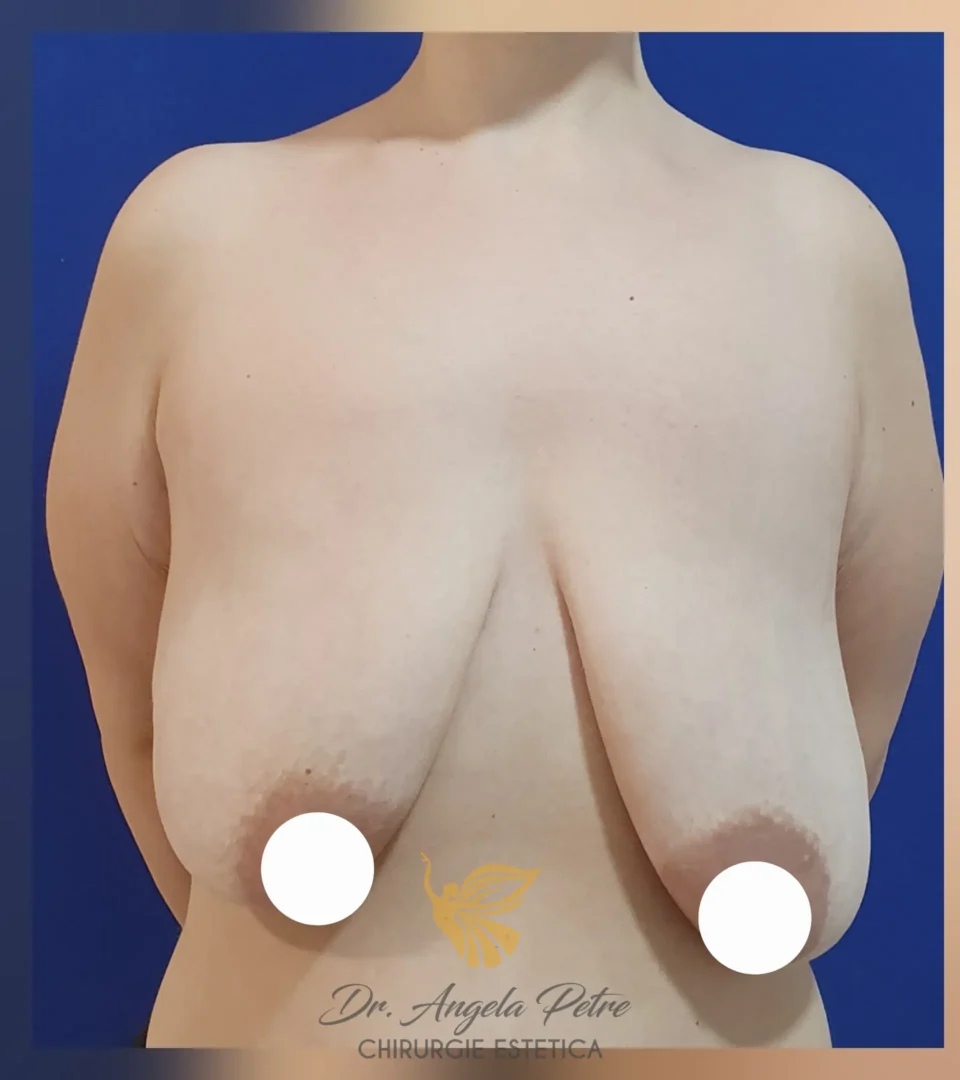 Caz 07 Mastopexie (ridicare sâni lăsați), frontal, before, Dr. Angela Petre - București