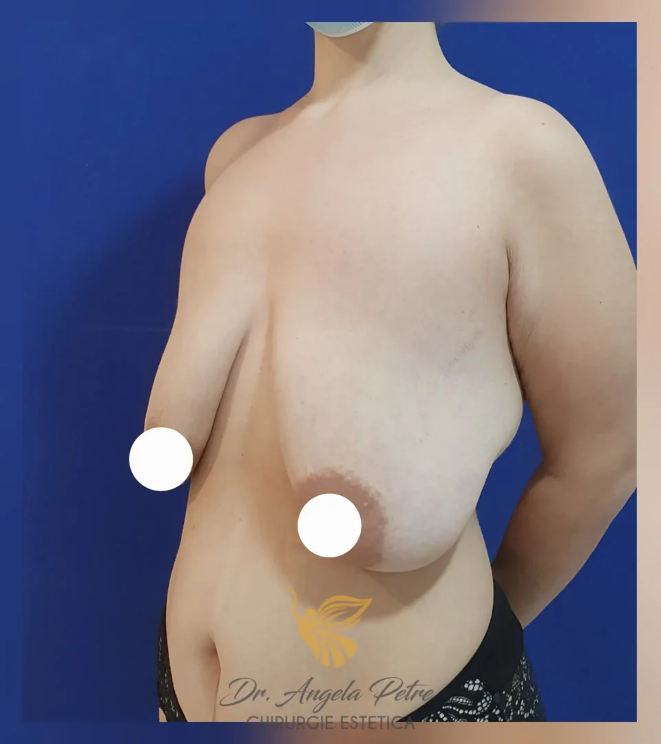 Caz 07 Mastopexie (ridicare sâni lăsați), semiprofil, before, Dr. Angela Petre - București