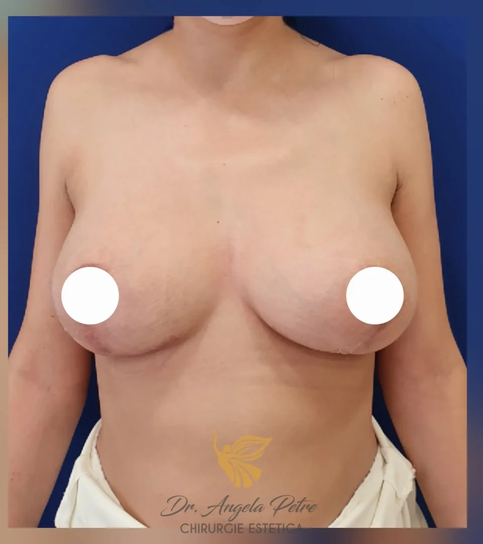 Caz 08 Mastopexie (ridicare sâni lăsați), frontal, after, Dr. Angela Petre - București