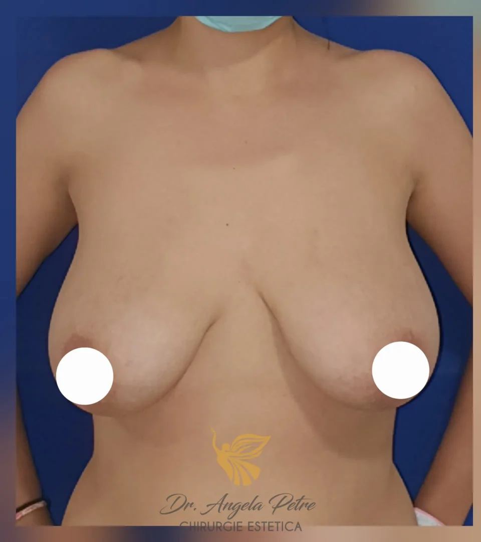 Caz 08 Mastopexie (ridicare sâni lăsați), frontal, before, Dr. Angela Petre - București