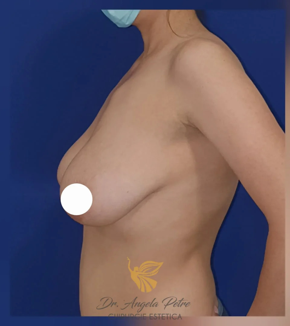 Caz 08 Mastopexie (ridicare sâni lăsați), profil, before, Dr. Angela Petre - București
