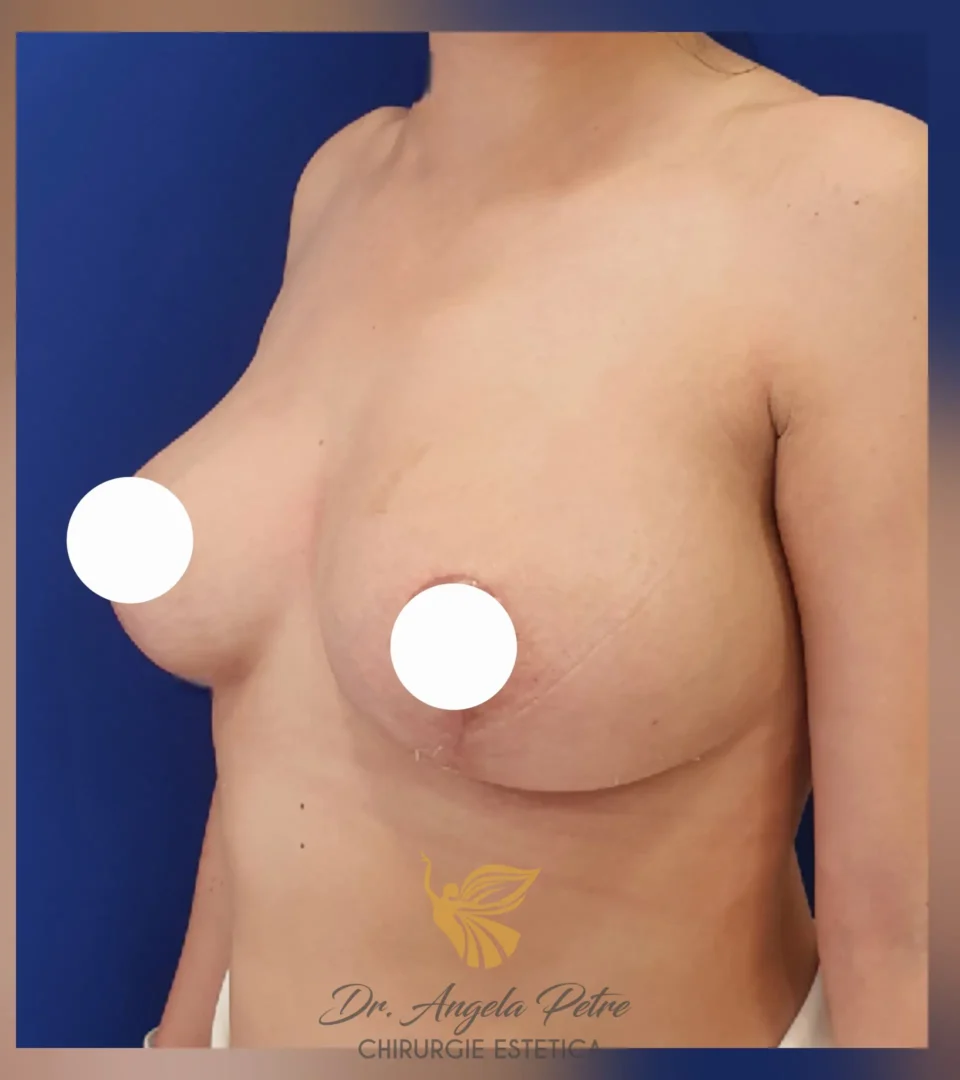 Caz 08 Mastopexie (ridicare sâni lăsați), semiprofil, after, Dr. Angela Petre - București