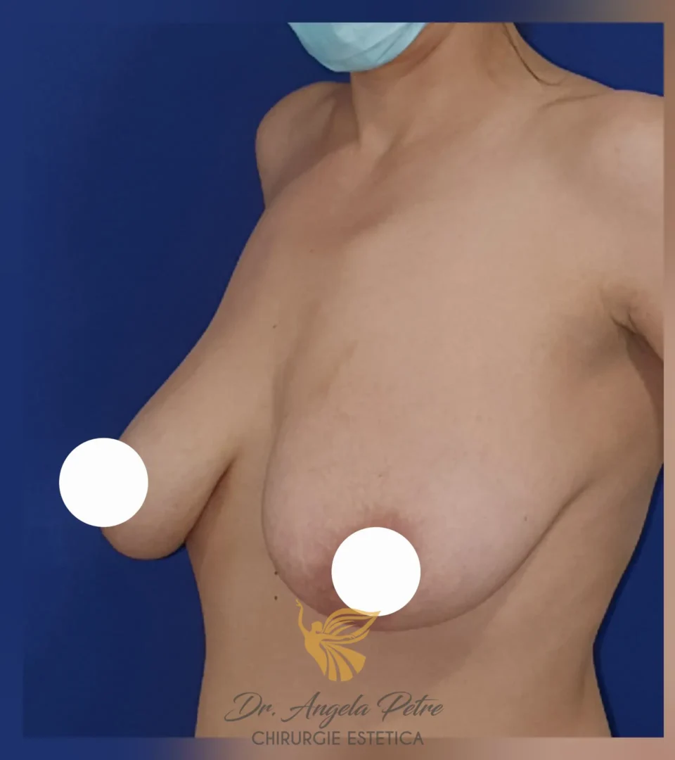Caz 08 Mastopexie (ridicare sâni lăsați), semiprofil, before, Dr. Angela Petre - București