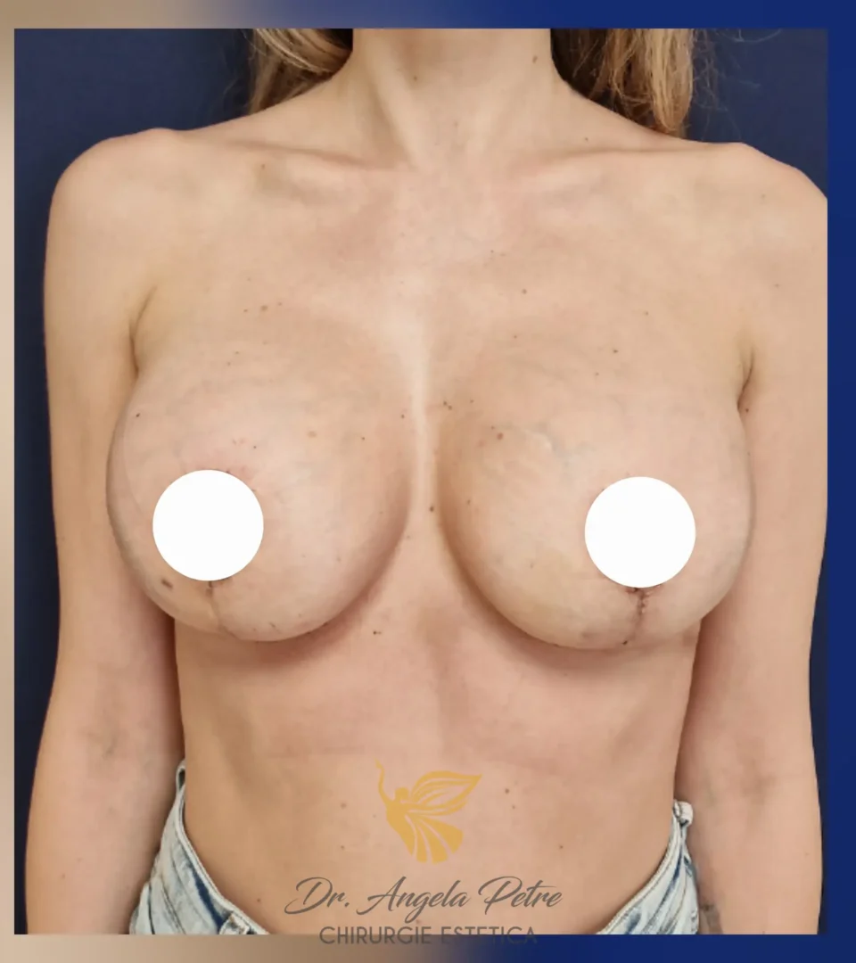 Caz 09 Mastopexie (ridicare sâni lăsați), frontal, after, Dr. Angela Petre - București