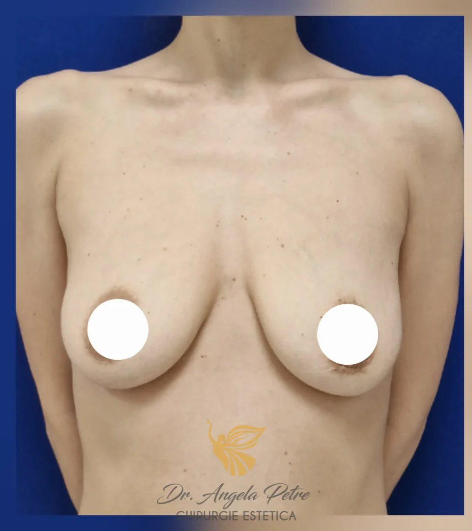 Caz 09 Mastopexie (ridicare sâni lăsați), frontal, before, Dr. Angela Petre - București