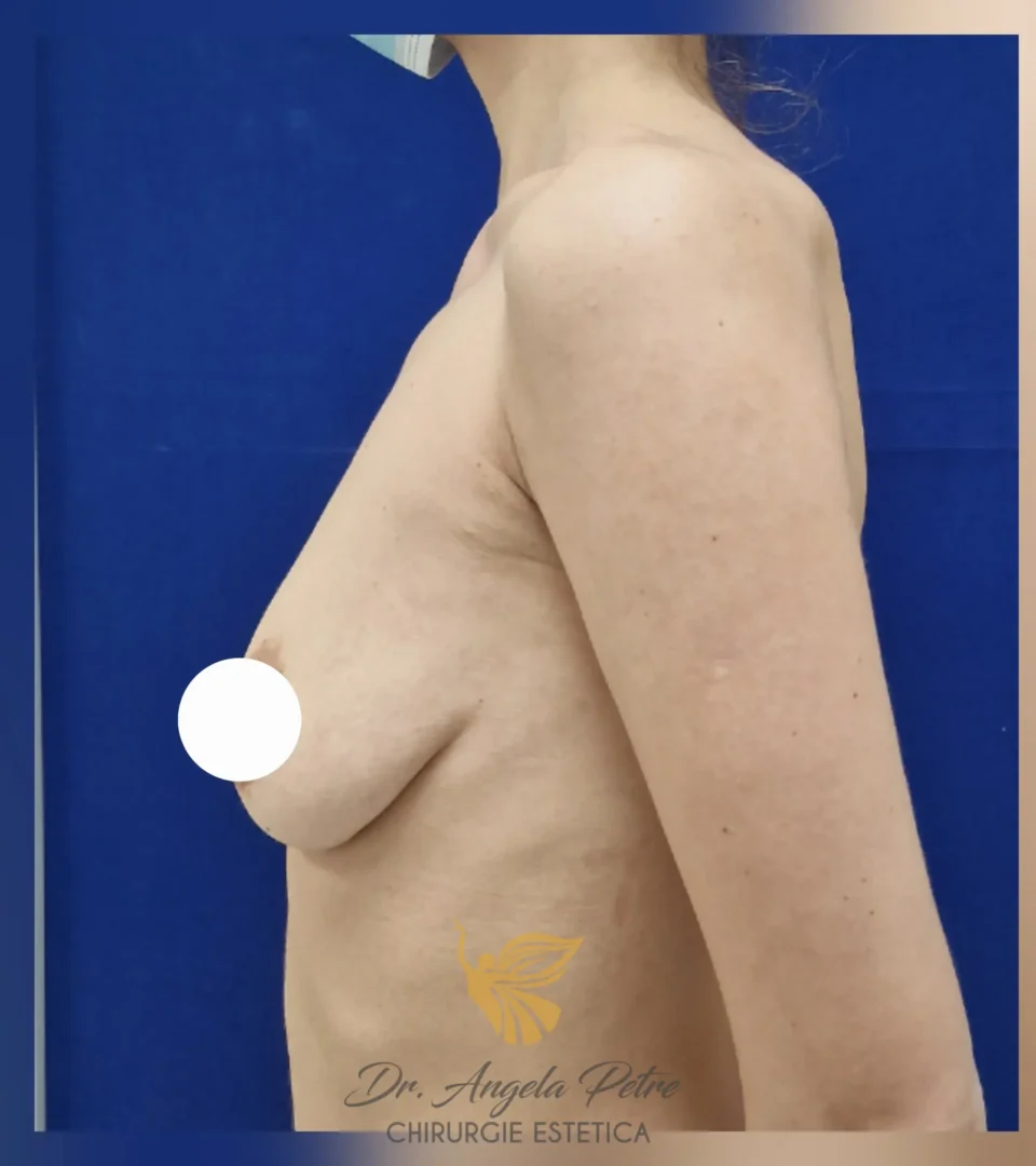 Caz 09 Mastopexie (ridicare sâni lăsați), profil, before, Dr. Angela Petre - București