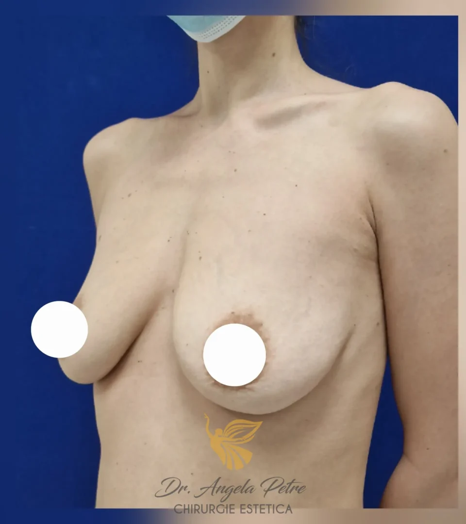 Caz 09 Mastopexie (ridicare sâni lăsați), semiprofil, before, Dr. Angela Petre - București