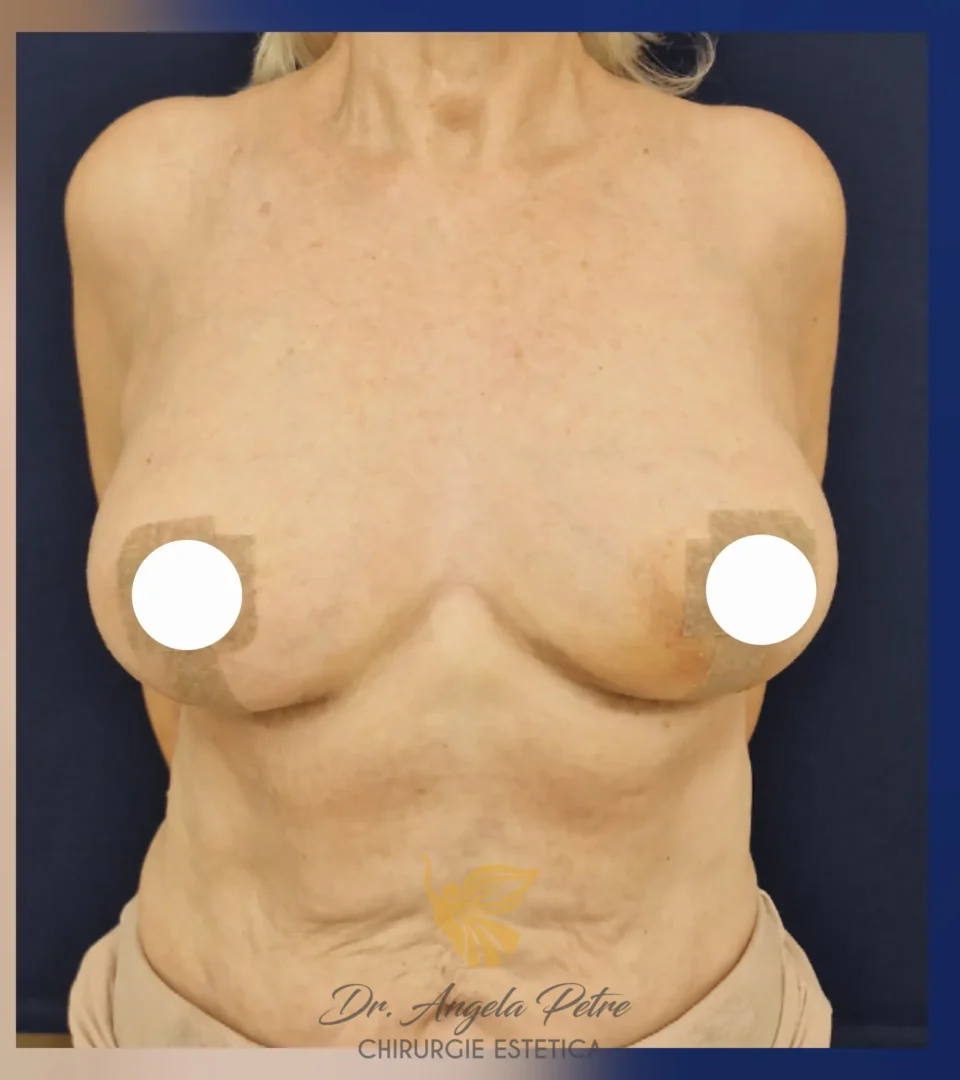 Caz 10 Reducție mamară (micșorare sâni), frontal, after, Dr. Angela Petre - București