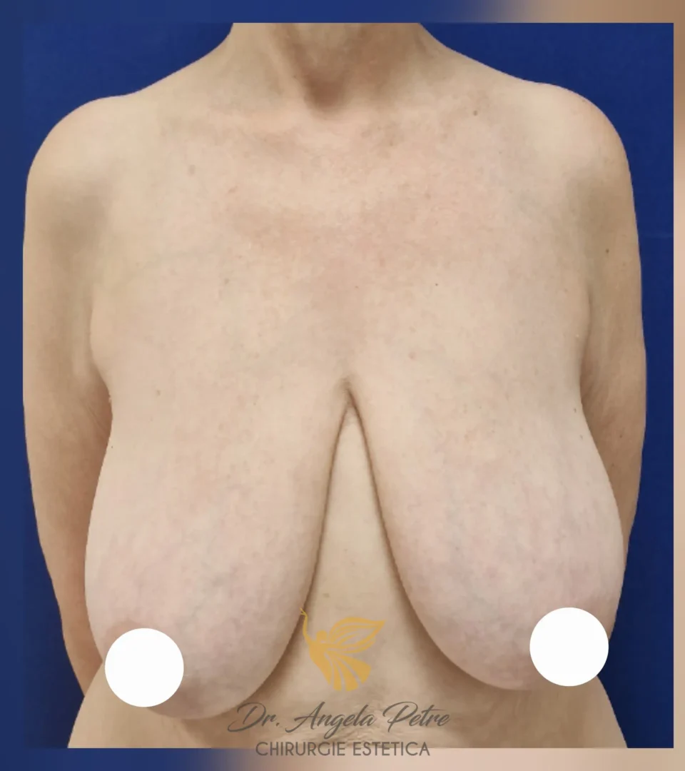 Caz 10 Reducție mamară (micșorare sâni), frontal, before, Dr. Angela Petre - București