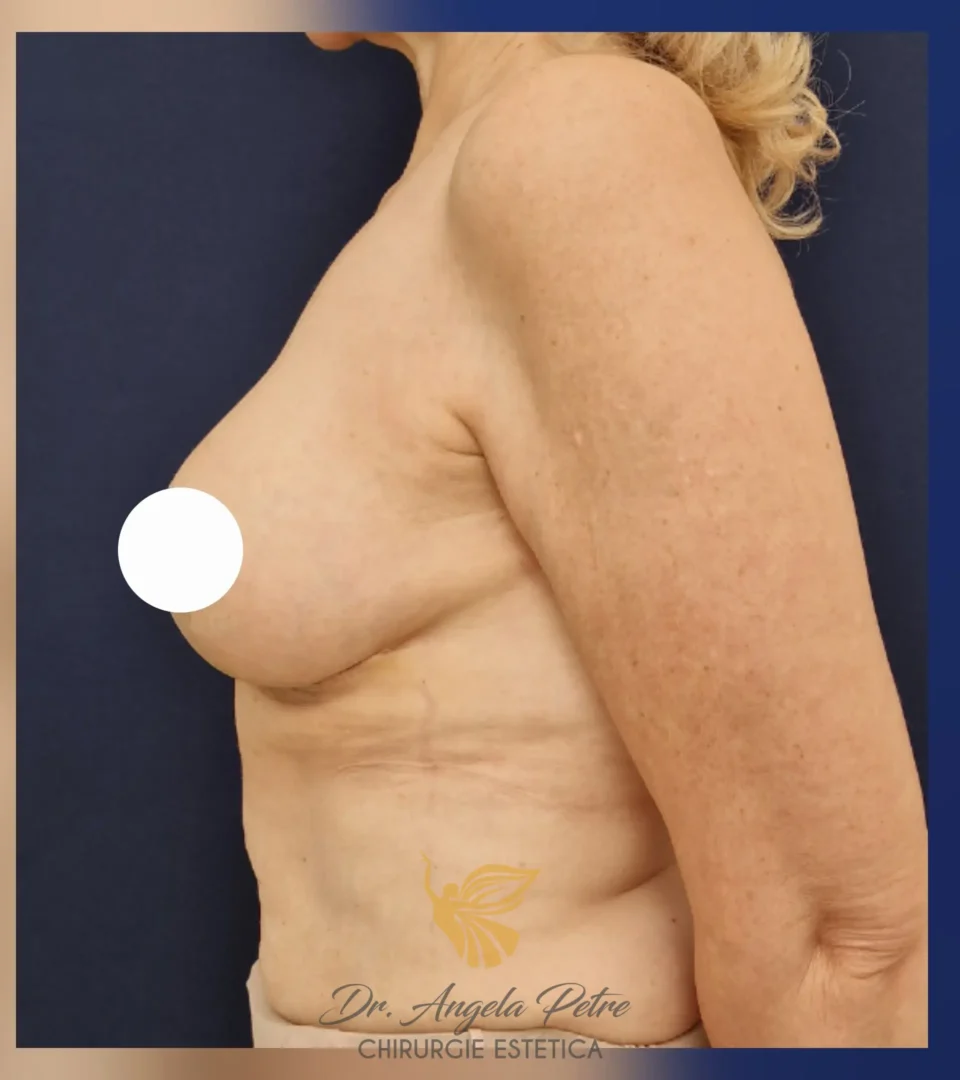 Caz 10 Reducție mamară (micșorare sâni), profil, after, Dr. Angela Petre - București