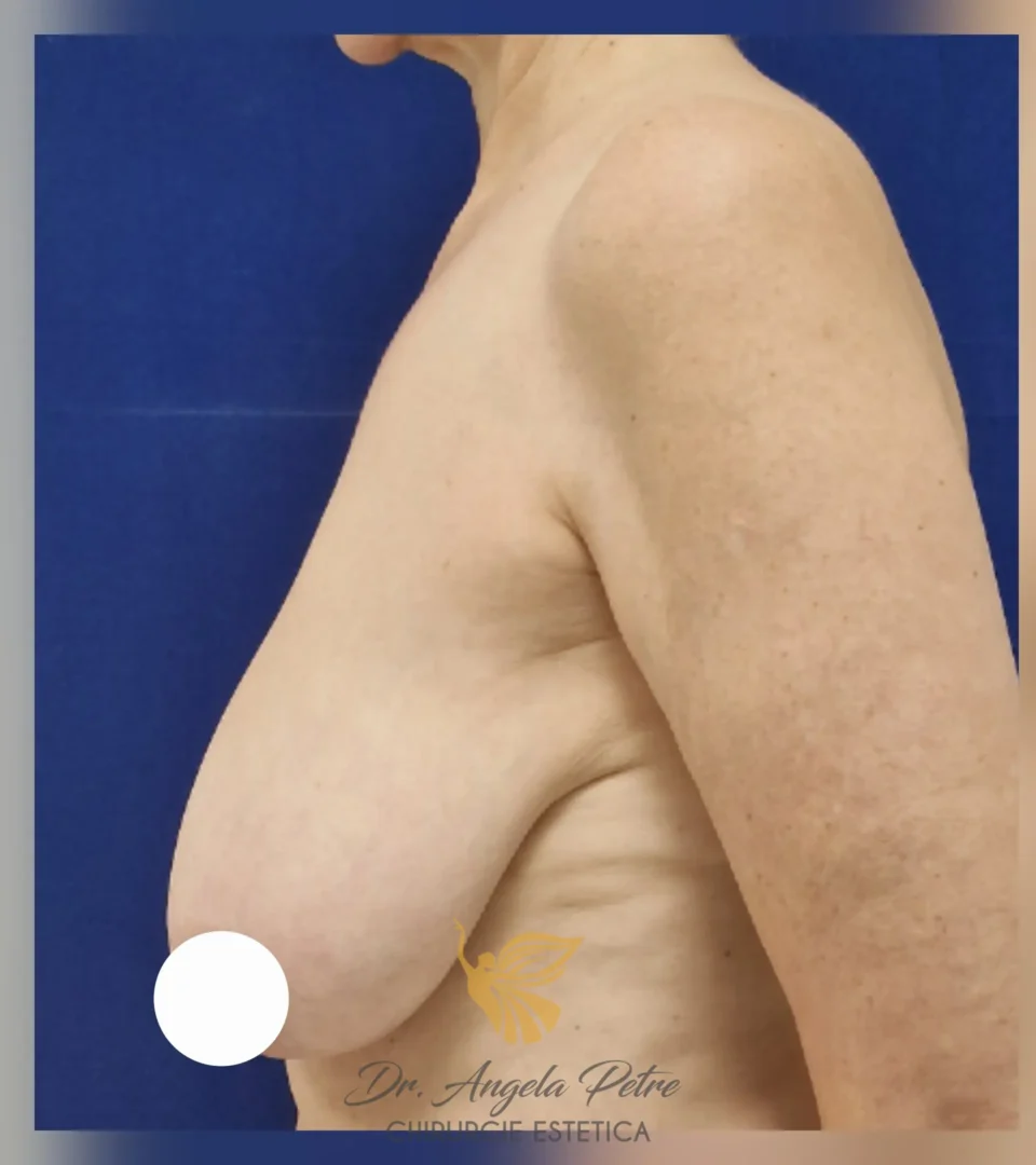 Caz 10 Reducție mamară (micșorare sâni), profil, before, Dr. Angela Petre - București