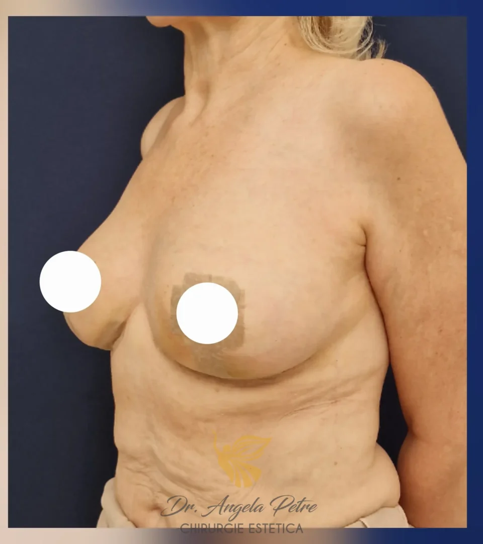 Caz 10 Reducție mamară (micșorare sâni), semiprofil, after, Dr. Angela Petre - București