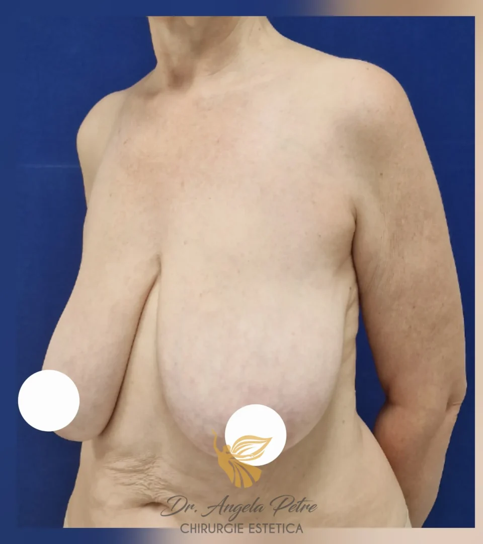 Caz 10 Reducție mamară (micșorare sâni), semiprofil, before, Dr. Angela Petre - București