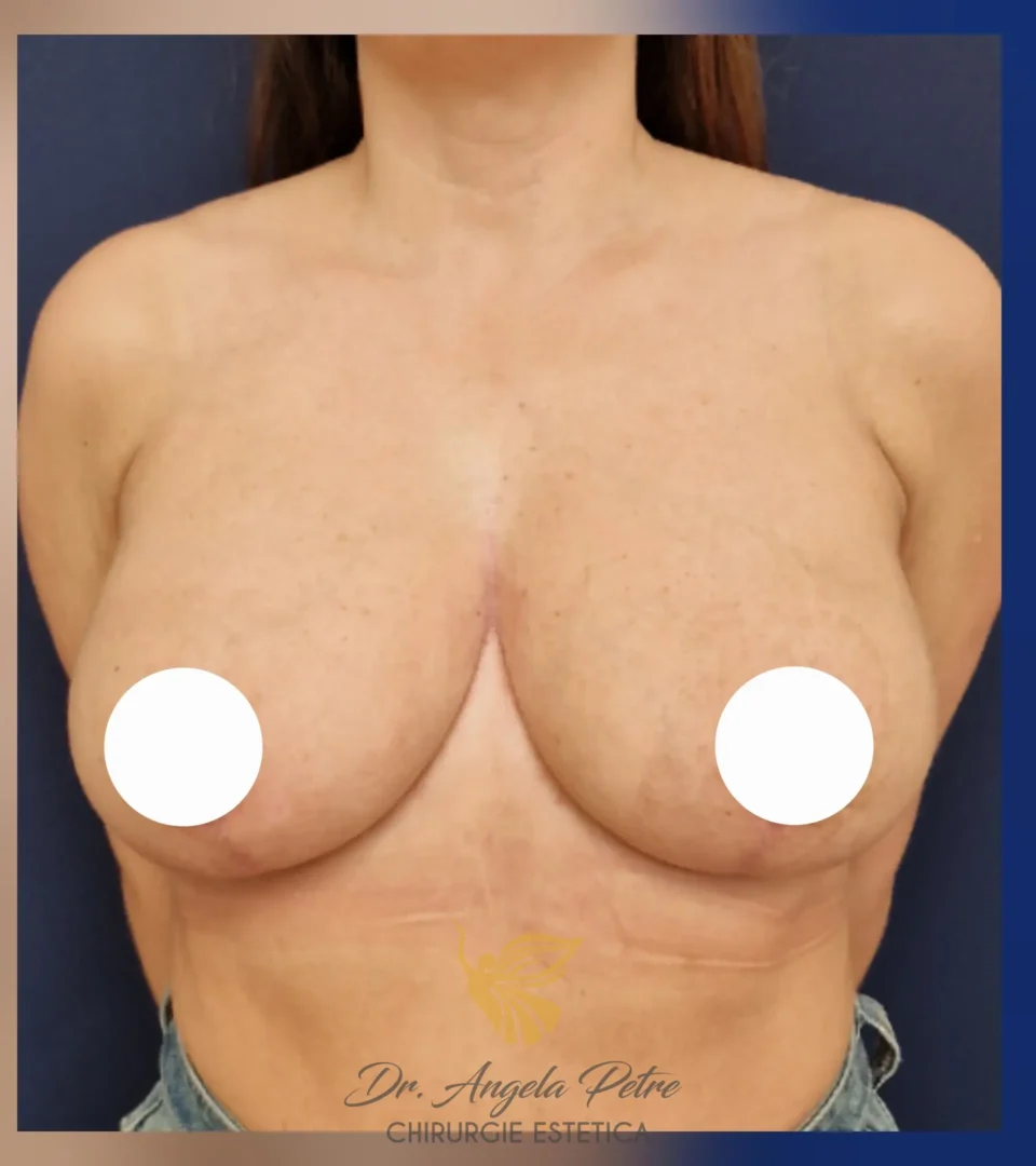 Caz 11 Reducție mamară (micșorare sâni), frontal, after, Dr. Angela Petre - București