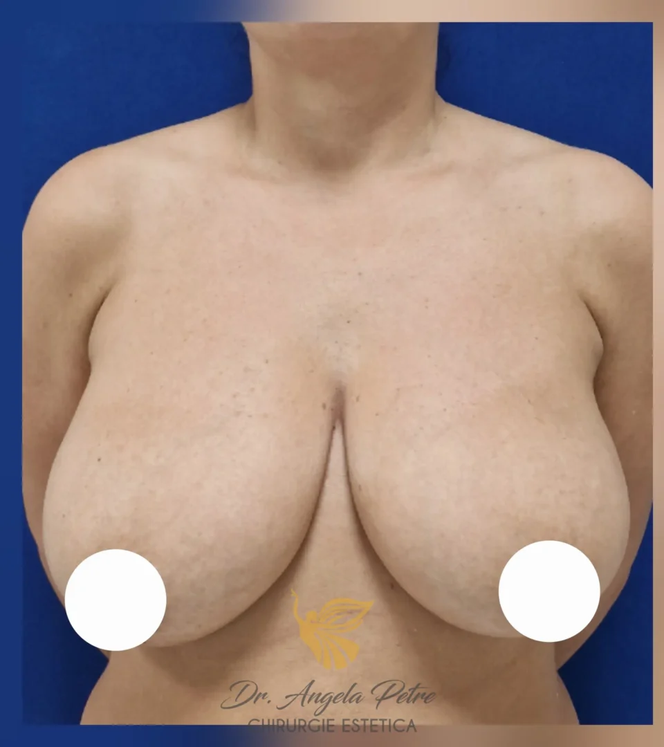 Caz 11 Reducție mamară (micșorare sâni), frontal, before, Dr. Angela Petre - București