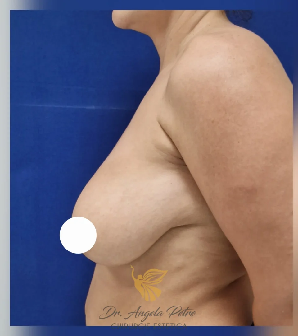 Caz 11 Reducție mamară (micșorare sâni), profil, before, Dr. Angela Petre - București
