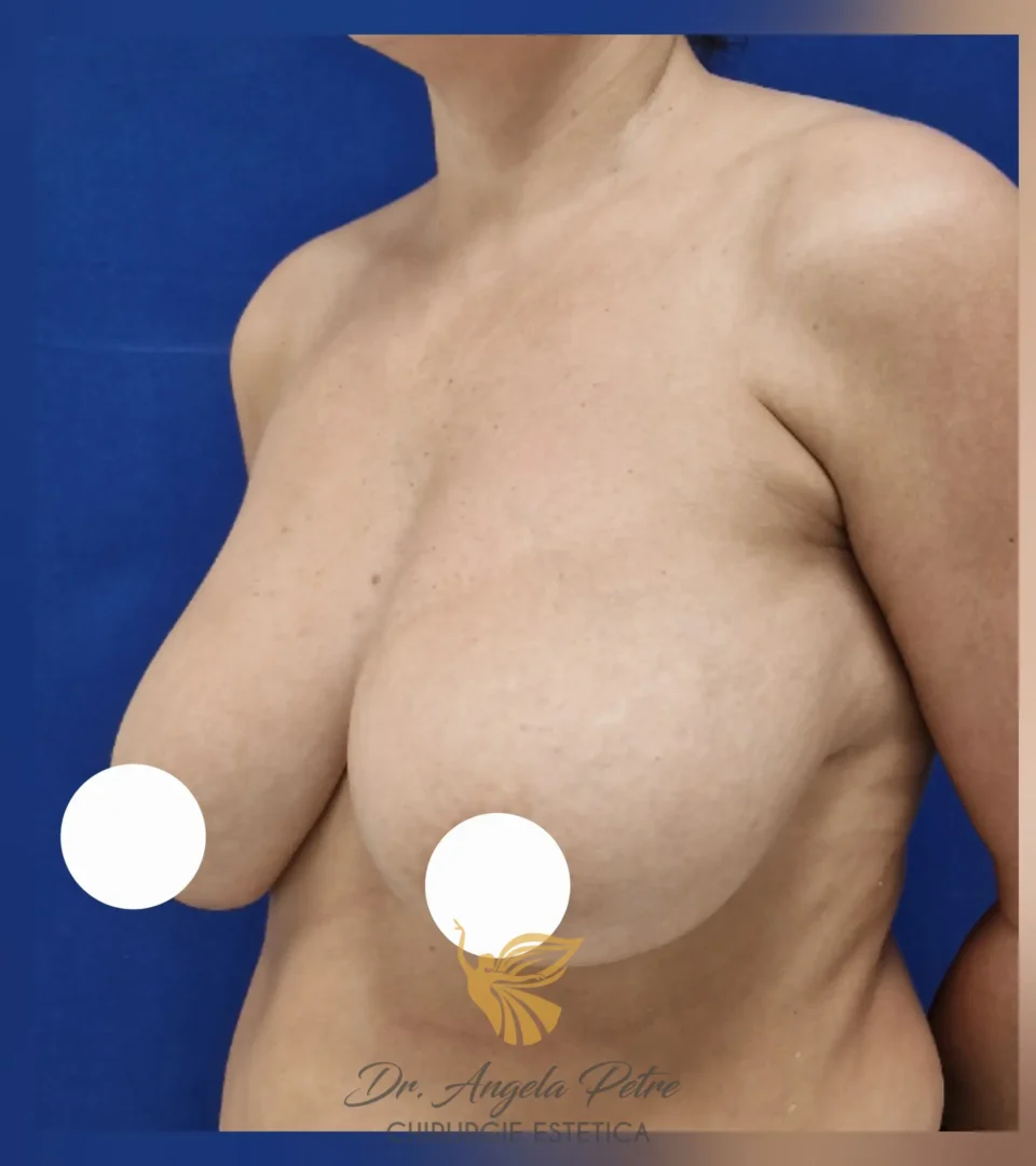 Caz 11 Reducție mamară (micșorare sâni), semiprofil, before, Dr. Angela Petre - București