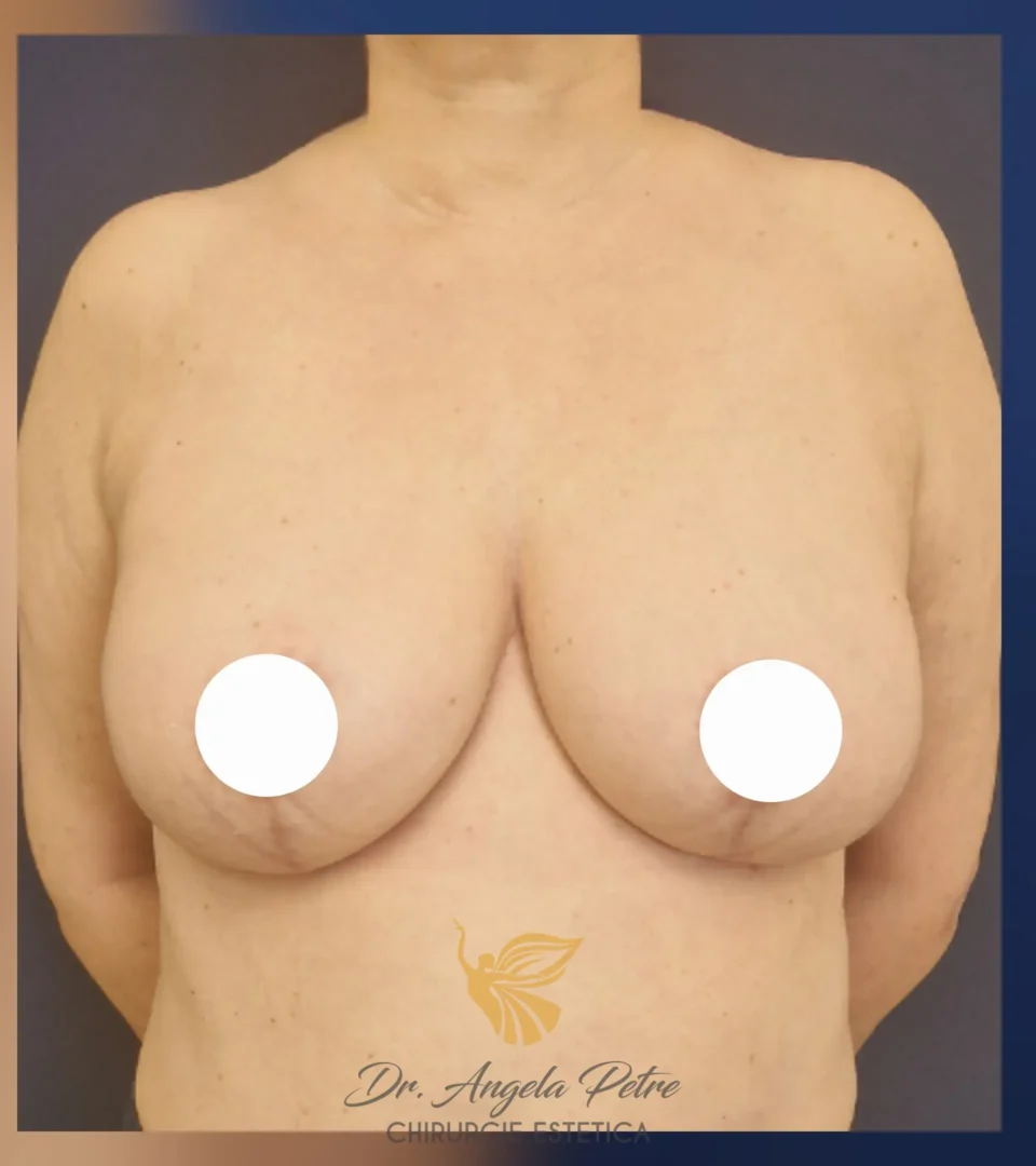 Caz 12 Reducție mamară (micșorare sâni), frontal, after, Dr. Angela Petre - București