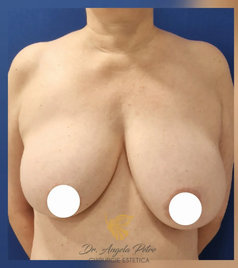 Caz 12 Reducție mamară (micșorare sâni), frontal, before, Dr. Angela Petre - București