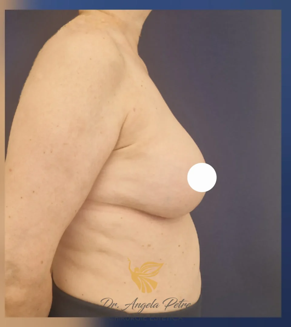 Caz 12 Reducție mamară (micșorare sâni), profil, after, Dr. Angela Petre - București