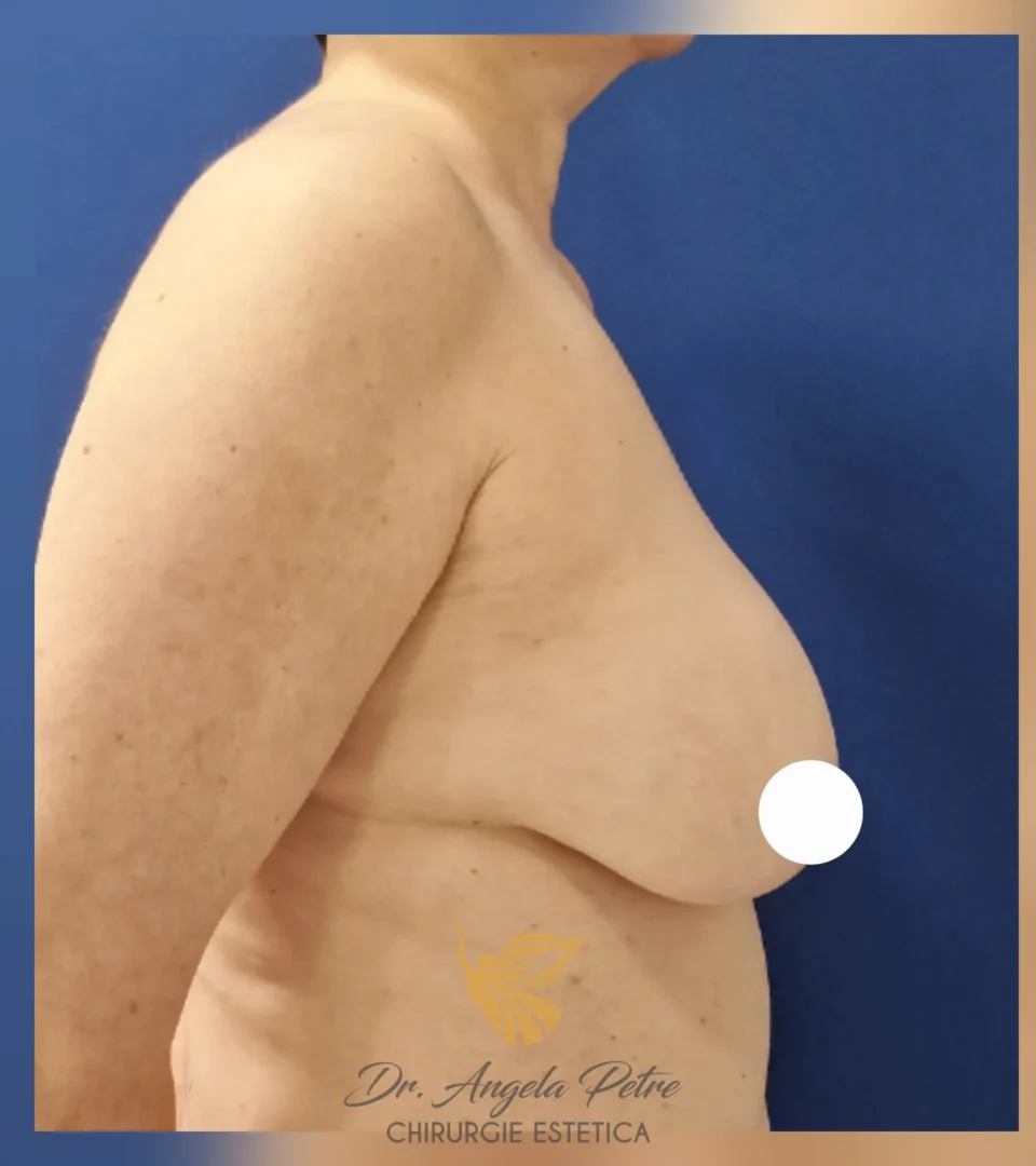Caz 12 Reducție mamară (micșorare sâni), profil, before, Dr. Angela Petre - București