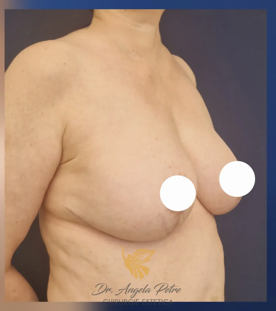 Caz 12 Reducție mamară (micșorare sâni), semiprofil, after, Dr. Angela Petre - București