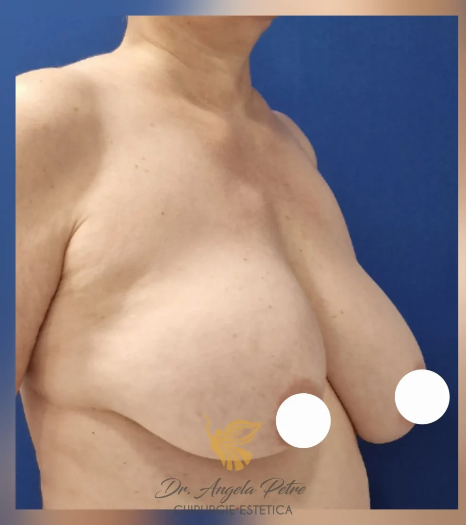 Caz 12 Reducție mamară (micșorare sâni), semiprofil, before, Dr. Angela Petre - București