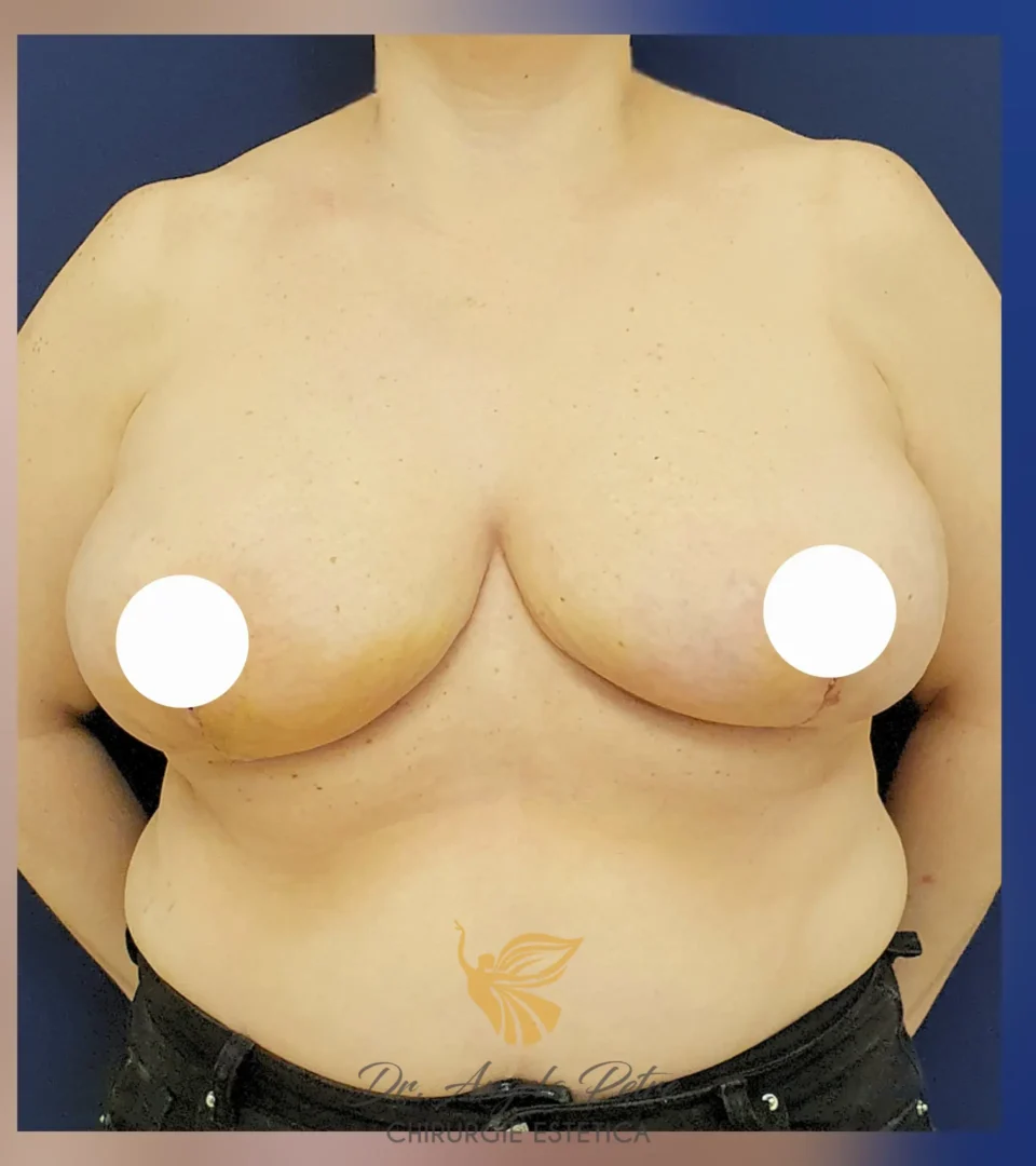 Caz 13 Reducție mamară (micșorare sâni), frontal, after, Dr. Angela Petre - București