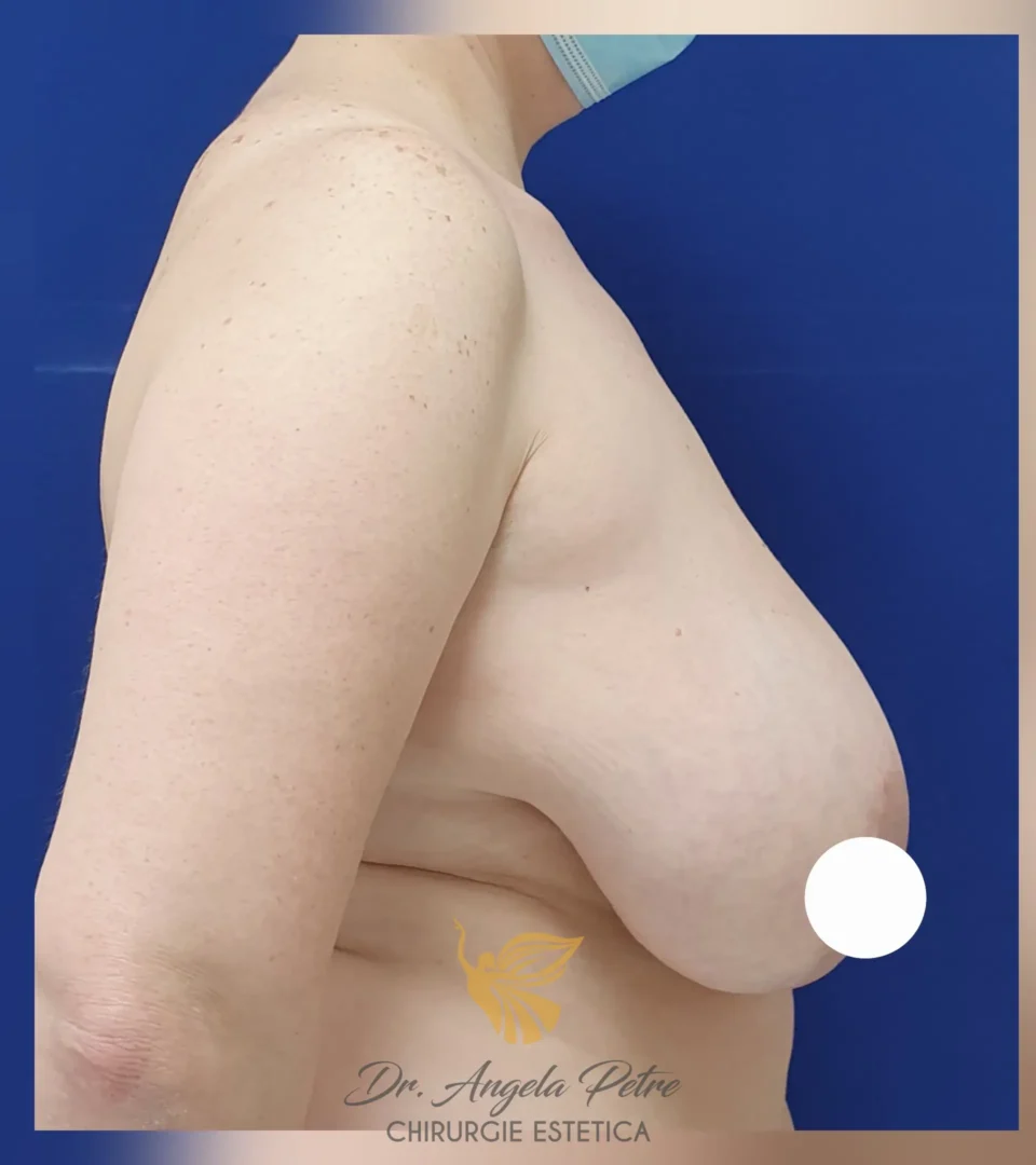 Caz 13 Reducție mamară (micșorare sâni), profil, before, Dr. Angela Petre - București
