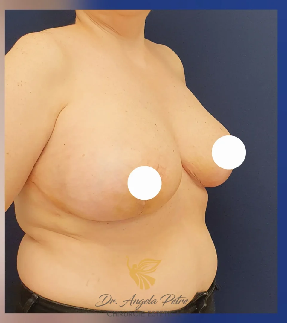 Caz 13 Reducție mamară (micșorare sâni), semiprofil, after, Dr. Angela Petre - București