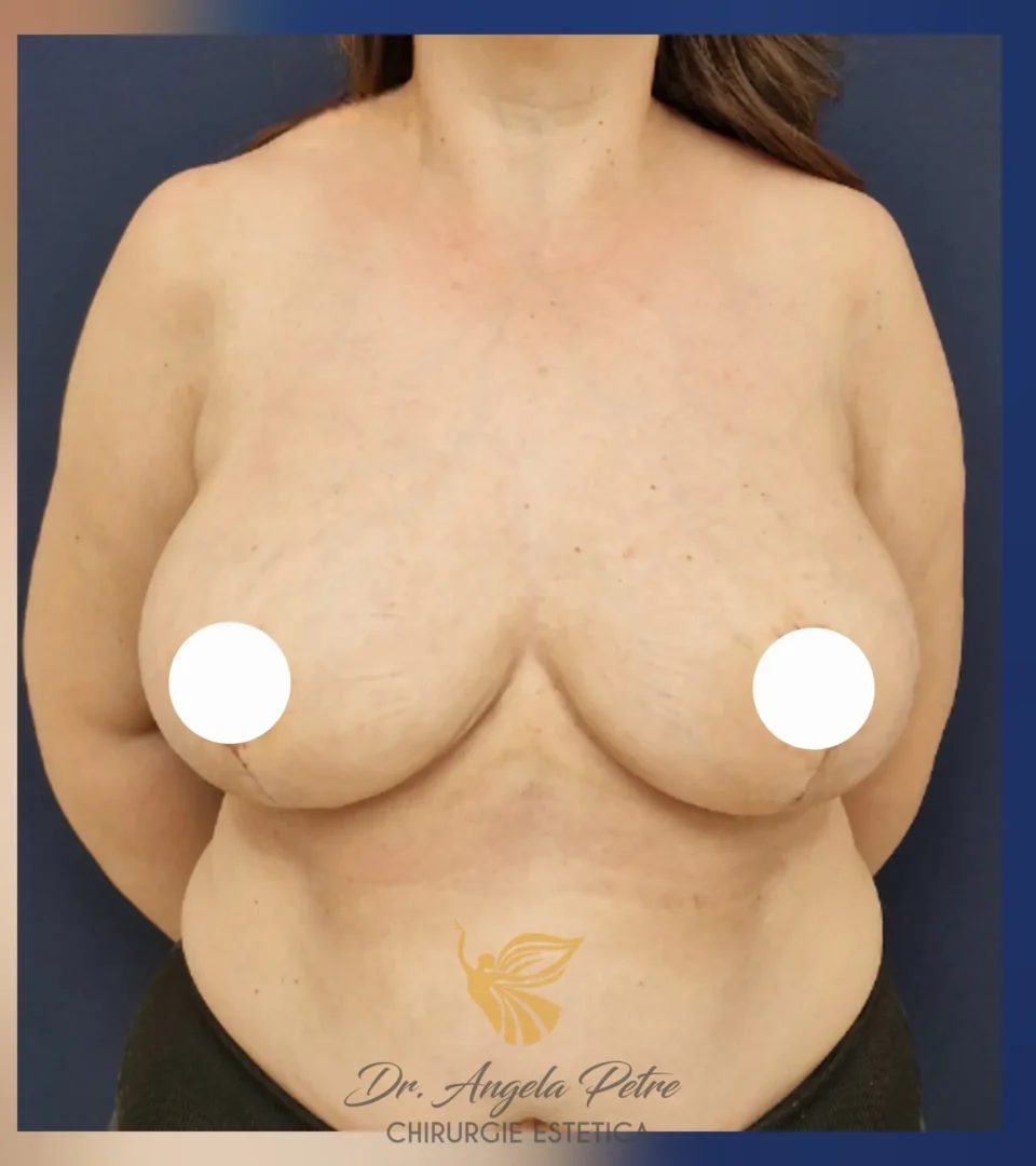 Caz 14 Reducție mamară (micșorare sâni), frontal, after, Dr. Angela Petre - București